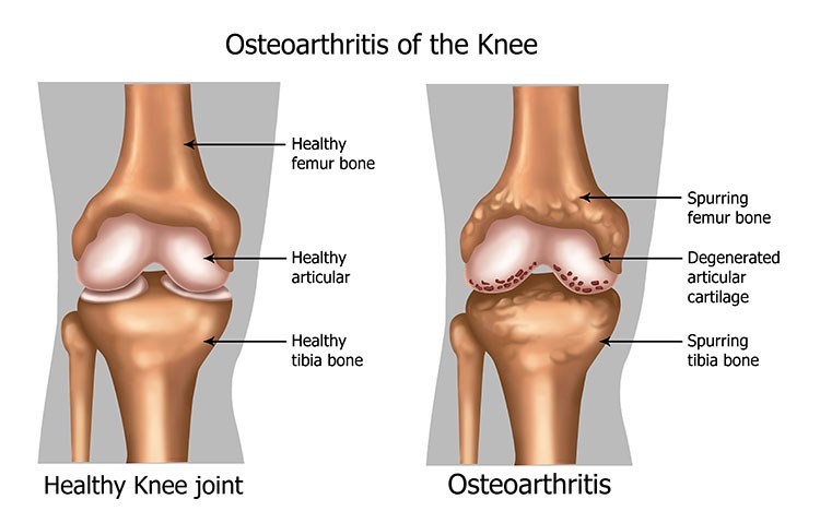Osteoarthritis Pain Relief In West Orange , NJ - West Orange Acupuncture Clinic