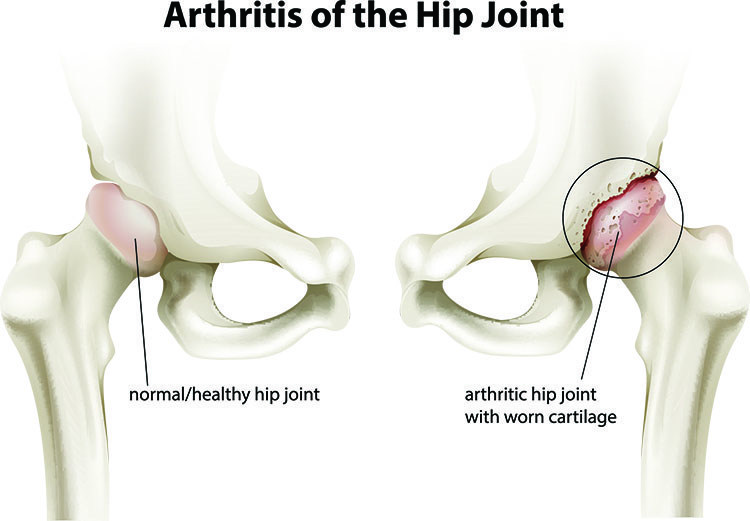 Arthritis Pain Relief In West Orange , NJ - West Orange Acupuncture Clinic