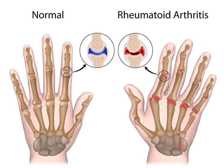 Rheumatoid Arthritis Pain Relief In West Orange , NJ - West Orange Acupuncture Clinic