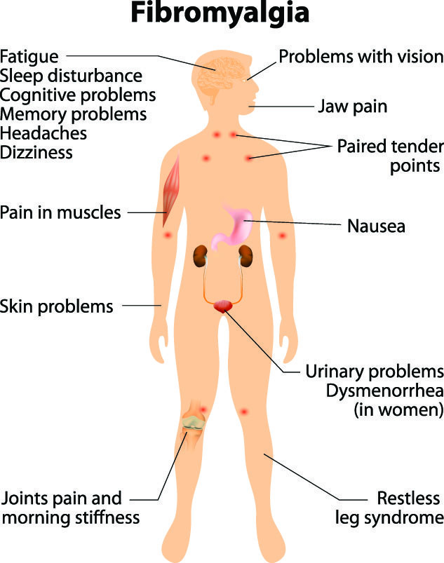 Fibromyalgia Natural Treatment With Chinese Medicine - West Orange Acupuncture Clinic